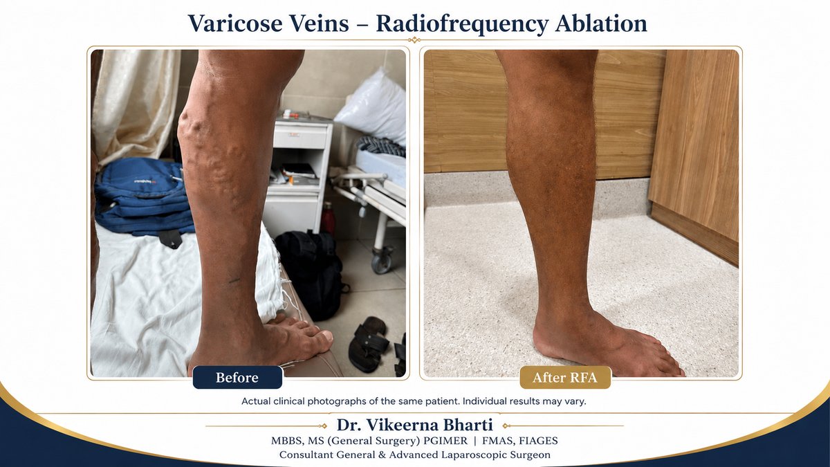 Varicose veins before and after Radiofrequency Ablation (RFA) — real patient result treated by Dr. Vikeerna Bharti in Ranchi