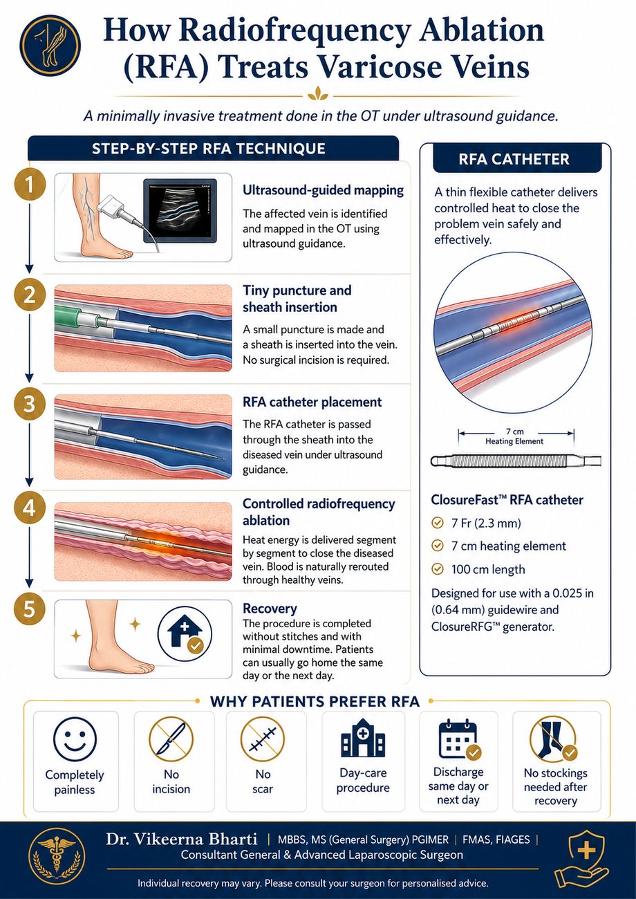 How Radiofrequency Ablation (RFA) treats varicose veins — step-by-step technique: ultrasound-guided mapping, sheath insertion, catheter placement, controlled ablation and recovery